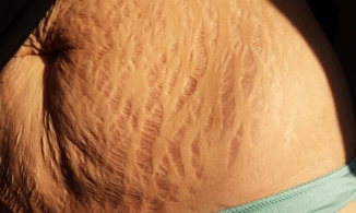 Làm thế nào để hạn chế rạn da? 