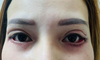Cảnh báo: Cắt mí sai cách, đôi mắt của cô gái 25 tuổi trở nên vô cùng đáng sợ