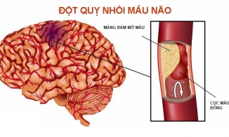 Dấu hiệu cảnh báo đột quỵ