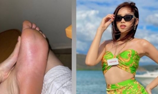 Đỗ Thị Hà bị ong chích sưng chân trong phần thi Người đẹp biển