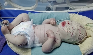Quảng Ninh: Bé trai sinh non bị đóng vảy cứng toàn thân như bọc xi măng