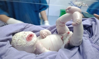 Nguyên nhân em bé ở Quảng Ninh có da như vảy cá