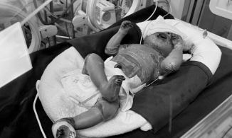 Quảng Ninh: Bé trai mắc bệnh da vảy cá tiên lượng nặng