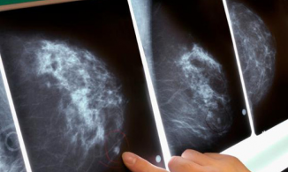 Hai chị em may mắn phát hiện ung thư vú cùng lúc nhờ nuôi chó