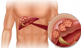 Việt Nam leo lên vị trí thứ 4 thế giới về tỷ lệ ung thư gan