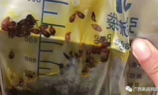 Cả đàn ký sinh trùng cư ngụ ở mật của người đàn ông 50 tuổi hay ăn cá sống