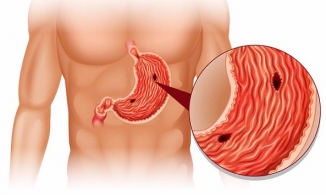 Quảng Ninh: Bé trai 11 tuổi bị thủng dạ dày do hay ăn cay
