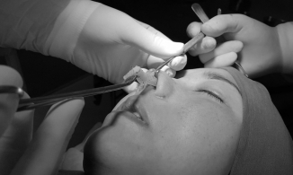 Nâng mũi bị thủng lại được tiêm kháng sinh vào mông