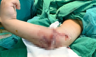 Cứu sống bé trai 8 tuổi bị đứt lìa cẳng tay