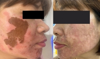 Trị nám không đúng cách ở Spa, người phụ nữ bị biến chứng