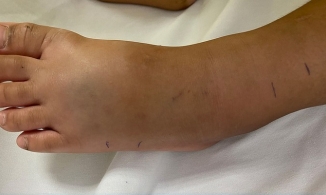 TP.HCM: Bé trai 4 tuổi bị rắn lục đuôi đỏ cắn