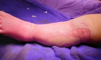 Bé trai 9 tháng tuổi tử vong vì đắp lá chữa bỏng nước sôi