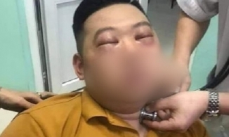 Sau khi thái hành, nam thanh niên bị sốc phản vệ nặng phải vào viện cấp cứu
