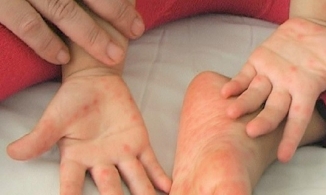 Dấu hiệu nhận biết và cách phòng tránh bệnh tay chân miệng 