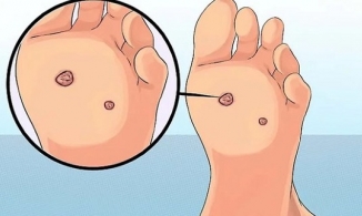 Dấu hiệu điển hình ở chân cảnh báo nguy cơ mắc ung thư cổ tử cung