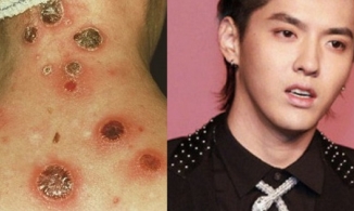 Bệnh giang mai mà Ngô Diệc Phàm bị đồn mắc phải nguy hiểm cỡ nào?