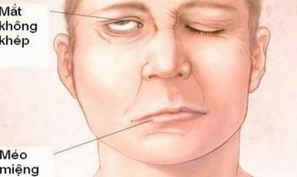 Liệt dây thần kinh số 7 mà Lou Hoàng mắc phải là bệnh gì, nguy hiểm ra sao?