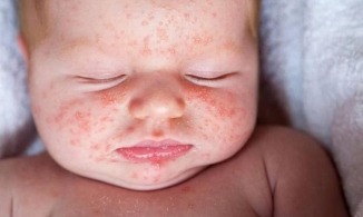 15% trẻ nhỏ có biểu hiện này khi nhiễm biến thể Omicron