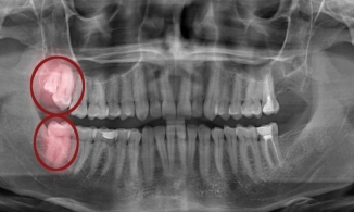 Vì sao mọc chỗ 'ngu' lại gây đau đớn nhưng lại được gọi là 'răng khôn'?