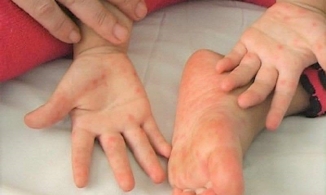 Bộ Y tế cảnh báo: 5.500 ca tay chân miệng, 1 trường hợp tử vong