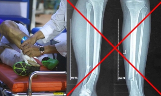 Thực hư về ảnh chụp X-quang chân của Hùng Dũng và chuyện thầy Park đập vỡ điện thoại trong bệnh viện