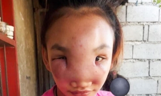 Nặn mụn trên mũi, gương mặt cô gái bị biến dạng và có nguy cơ bị mù