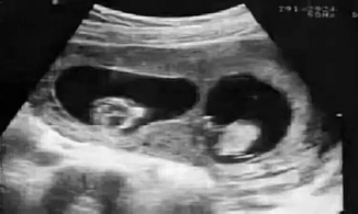 Hi hữu đứa bé sơ sinh có ADN giống chú ruột nhưng bố lại là con một