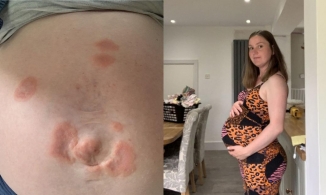 Người phụ nữ mắc bệnh dị ứng với đứa con của mình, cứ đứng gần là nổi mụn