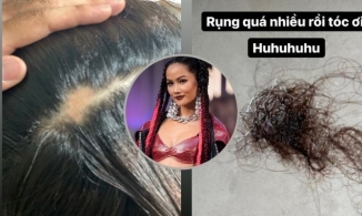 Top 5 Hoa hậu Hoàn vũ thế giới H'Hen Niê bị hói ở tuổi 30, khổ sở vì tóc rụng cả mảng