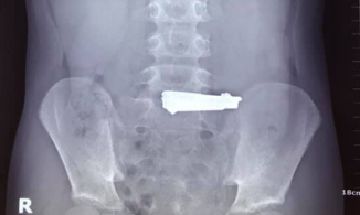 Phú Thọ: Bé trai 9 tuổi nuốt bấm móng tay vì bắt chước trên YouTube