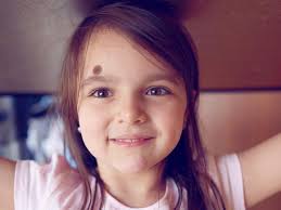 Nhân tướng học: Vết chàm, vết bớt ẩn chứa điều gì?