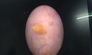 Chuyện hy hữu: Hạt thóc 'đi lạc' vào bàng quang của bé gái 26 tháng tuổi