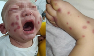 Việt Nam phát hiện và điều trị một ca bệnh cực hiếm, cả thế giới chỉ có 300-500 người.