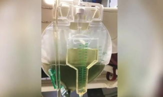 Kỳ lạ nước tiểu của bệnh nhân 62 tuổi chuyển màu xanh lá sau 5 ngày nằm viện