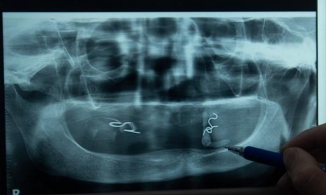 Hà Nội: Bệnh nhân mọc sỏi trong miệng