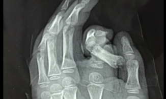 Hà Nội: Đút tay vào máy giặt, bé trai bị đứt ngón trỏ