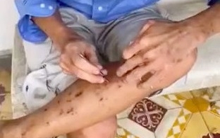 TP.HCM: Người đàn ông bị hoang tưởng nhiễm ký sinh trùng