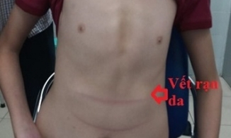 Thanh Hoá: Bé trai 11 tuổi cao 1m8, lồng ngực nhô ra như ức gà