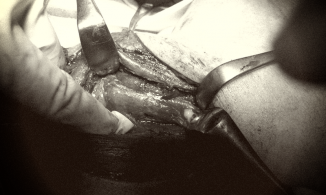 Phát hiện vi khuẩn kháng nhiều loại kháng sinh trong ổ áp xe giáp