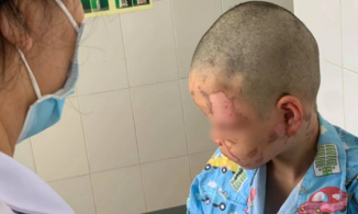 Quảng Ninh: Làm theo clip trên mạng, bé trai 10 tuổi tự mua cồn về đốt gây bỏng toàn bộ mặt