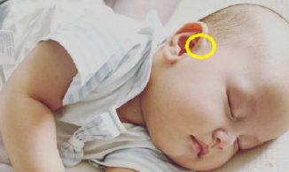 Rò luân nhĩ: Dị tật bẩm sinh mà hai con trai của Hồ Ngọc Hà mắc phải là bệnh gì?