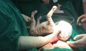 Yên Bái: Bé trai chào đời bị da vảy cá, bị vảy trắng bao phủ toàn thân với nhiều vết rạn chảy máu