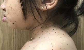 Việt Nam ghi nhận trường hợp đầu tiên mắc hội chứng da báo