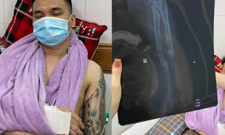 Nam ca sĩ Khắc Việt bị gãy cổ tay khi tập thể thao, hủy hàng loạt show diễn