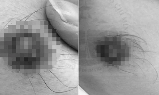 TP.HCM: Nam thanh niên mắc giang mai vú, thế giới chỉ ghi nhận 13 ca