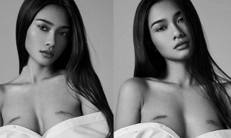 Hoa hậu Myanmar - đối thủ mà Khánh Vân giúp đỡ - có hai vết sẹo lớn ở ngực