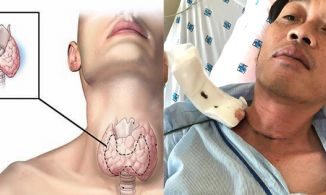 Bệnh ung thư tuyến giáp mà Hoài Linh mắc phải là gì, có nguy hiểm không?