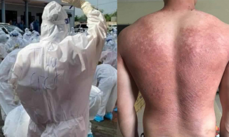 Xót xa hình ảnh tấm lưng cháy nắng phồng rộp của bác sĩ tại tâm dịch Bắc Giang