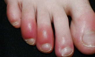 Chuyên gia y tế thế giới cảnh báo triệu chứng mới của người nhiễm Covid-19