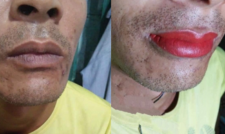 Ông bố nghe lời hàng xóm đi khử môi thâm và kết quả